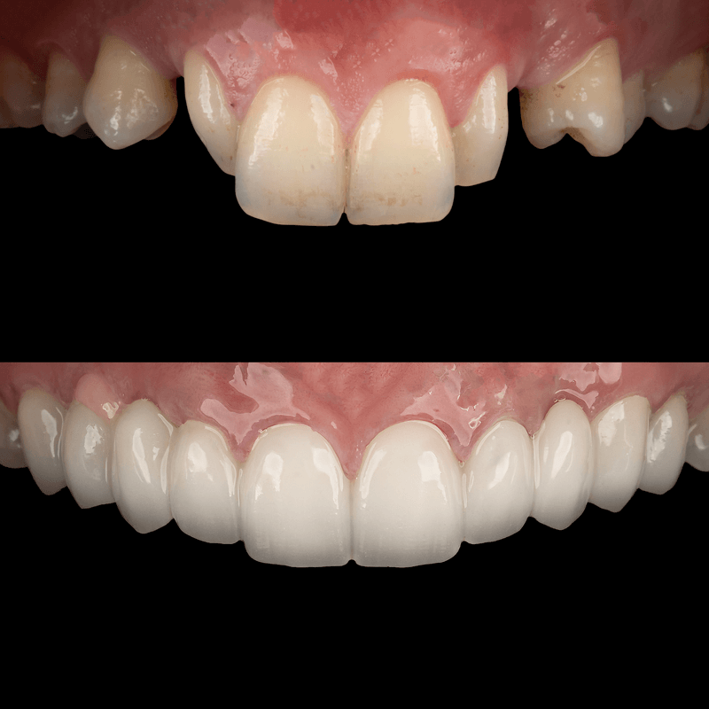 Emax-zirkonyum Multilayer Restorasyon