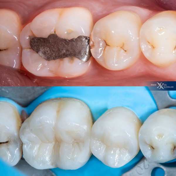 Amalgam Smart Protokolü