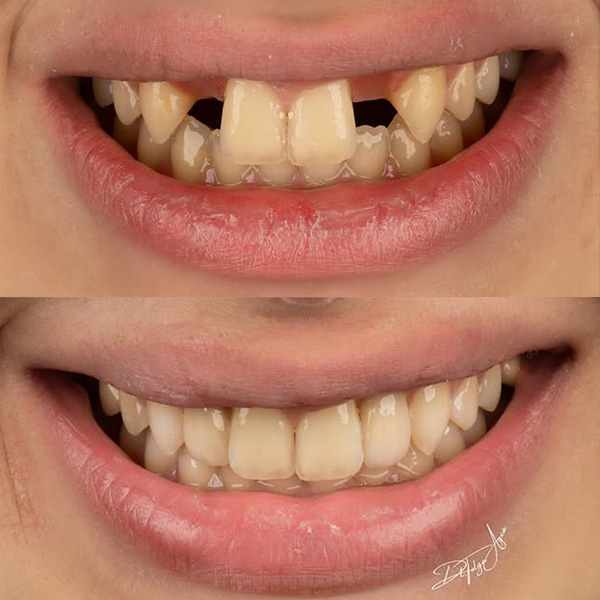 Ortodonti ve İmplant Ortaklığıyla Kusursuz Gülüş