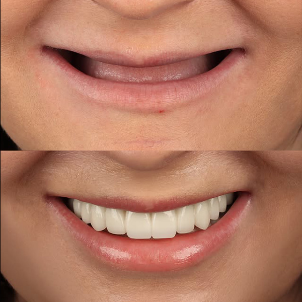 İleri İmplant Cerrahisi ile Tam Ağız Rehabilitasyonu: 10 Dental İmplant