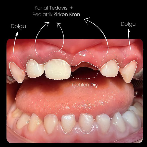 Süt Dişleri Koruması