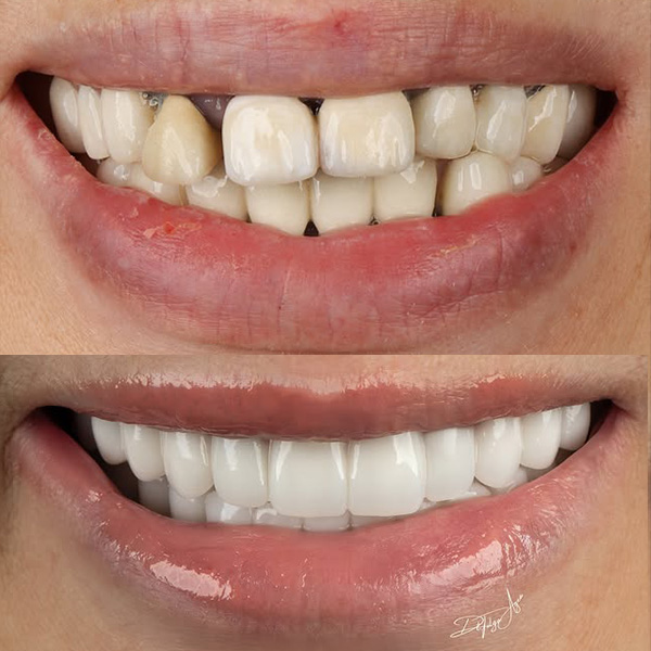 Dental İmplantlar Üzerine Sabit Monolitik Zirkonyum Restorasyon
