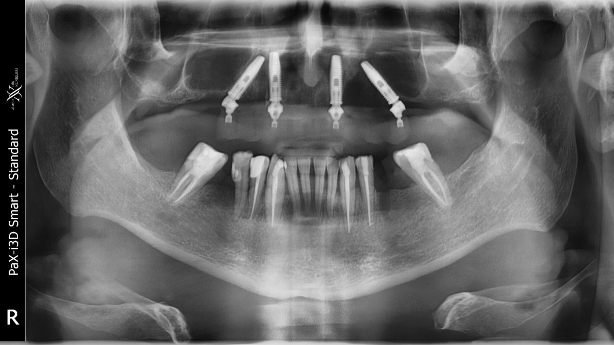 Dental Tomografi ile Panoramik Film Arasındaki Farklar Nelerdir? Dental Tomografi ile Panoramik Film Arasındaki Farklar Nelerdir?