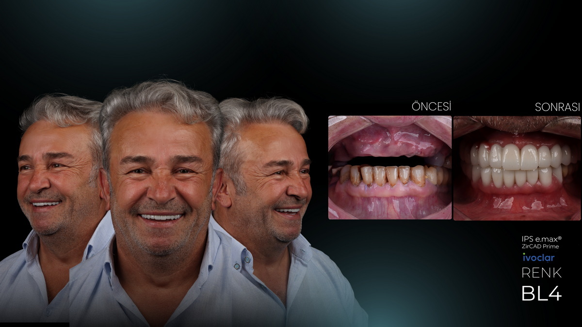 Estetik Diş Hekimliğinin Hastaya Katkıları Kişiye Özel Gülüş Estetiği ve Artan Özgüven
